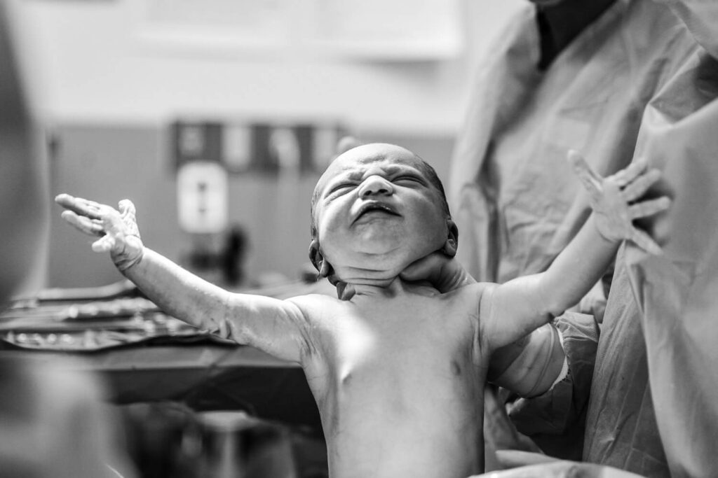 Kaiserschnitt im Krankenhaus begleitet durch Geburtsfotograf Julia Schlenkrich Fotografie in Hannover, Blick auf Baby, welches gerade aus dem Bauch gezogen wird und von einem Arzt am Kopf gehalten wird.